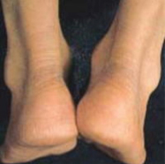 黄色腫により太くなったアキレス腱