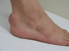 踵に発生した黄色腫